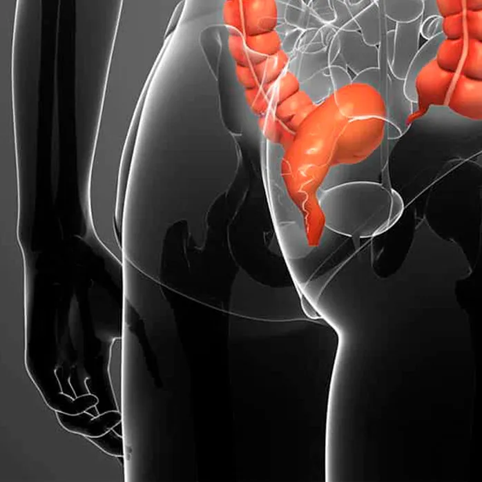 Imagem representativa de cancer anal